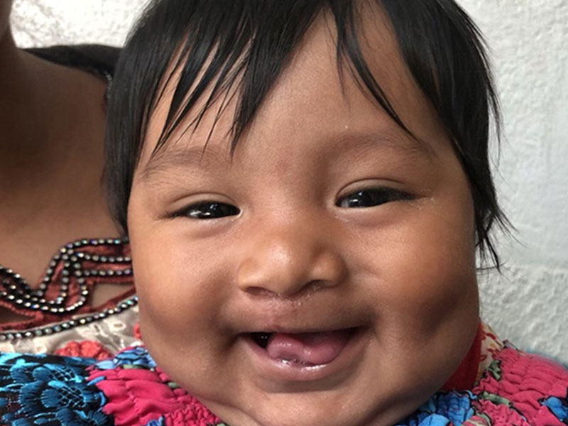 Cleft Lip and Cleft Palate Surgery | HUGS Foundation, Inc.  